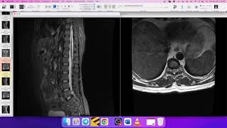 HOW TO REPORT LUMBAR SPINE MRI [upl. by Eidorb]