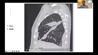 Interstitial pulmonary edema with fissural effusion Arabic version [upl. by Corenda229]