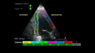 RESTRICITIVE CARDIOMYOPATHY ECHO [upl. by Alpers]