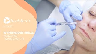 Wypełnianie bruzd nosowowargowych  JUVEDERM® VOLIFT  Klinika VESUNA [upl. by Zitella732]