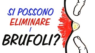 Si possono eliminare i brufoli LA SCIENZA DELLACNE [upl. by Ettigirb416]