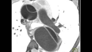 Cardiac prosthetic aortic valve 4 of 4 [upl. by Ycnaffit839]