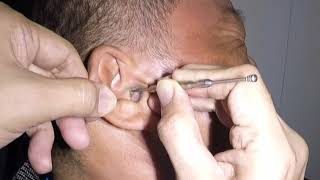 Something MASSIVE Stuck amp Removed From Mans Ear [upl. by Macleod6]