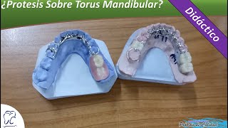 Didáctico 16  ¿Prótesis Sobre Torus Mandibulares [upl. by Nahsyar]