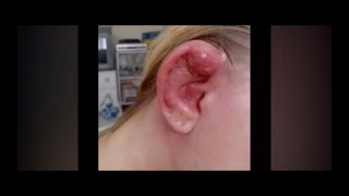 Infected Industrial Piercing 2008 [upl. by Jareen]