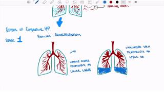 Congestive Heart Failure [upl. by Leamaj248]