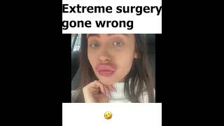 This woman from Russia posted her botched lip job to Reddit Would you get the same [upl. by Nahej]