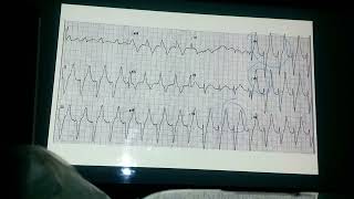 continuación de Taquiarritmias [upl. by Llennehc]
