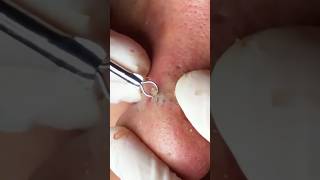 Éclatement de Boutons Extrêmeblackheads acne asmrvideo [upl. by Sofia]