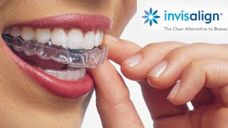 Watch this video before starting INVISALIGN  Starter Kit  Price  Dental Treatment [upl. by Frechette589]