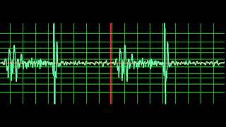 Ventricular Septal Defect normal speed [upl. by Lashonda]