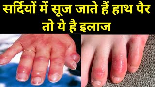 सर्दियों में हाथ पैर सूजन Home Remedy for RednessSwelling Fingers sardi me hath par sujan ka ilaj [upl. by Ellirehs]