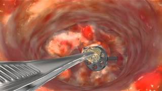 Animation Scar Tissue Removal to Release TORP [upl. by Eiralav]