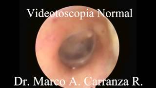 Video Otoscopia Normal [upl. by Landsman]