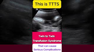 TTTS  Twin to Twin Transfusion Syndrome Ultrasound  Monochorionic TWINS [upl. by Yeknarf]