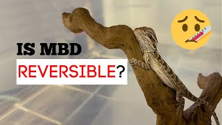 Metabolic Bone Disease Causes and Prevention [upl. by Claudette284]