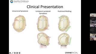 Craniosynostosis [upl. by Nahtanoj]