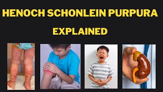 Henoch Schonlein Purpura IgA vasculitis Pathophysiology presentations investigations and treatment [upl. by Anaujat]