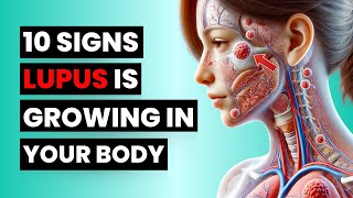 Dont Miss These 10 Early Lupus Signs – It Could Save You [upl. by Vita]