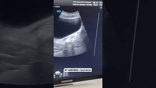 RT URETERIC CALCULUS usg humanbody radiology urinarybladder [upl. by Kylila]