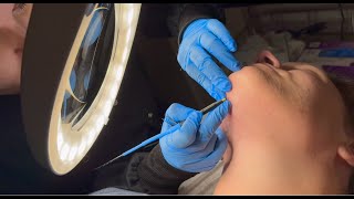 165 Hours of Electrolysis  Permanent Facial Hair Removal TimeLapse  PCOS Hirsutism [upl. by Cohberg]