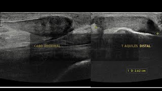 CASO DESGARRO COMPLETO DEL TENDON DE AQUILES [upl. by Lynden738]