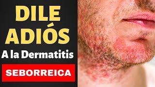 Remedios Caseros para la DERMATITIS SEBORREICA  Tratamientos para la Dermatitis Seborreica [upl. by Rheta865]