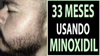 33 MESES USANDO MINOXIDIL [upl. by Sinned]