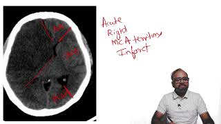 SPOTTERZ  03  Brain hypodensity in a typical vascular territory [upl. by Anileh958]