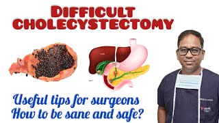 Cholecystectomy being safe and sanetips for surgeonsbest Laparoscopic surgery [upl. by Hbaruas]