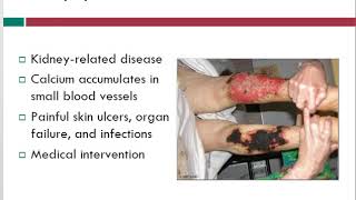 Calciphylaxis  Wound Care Topics  Free Wound Care Info  WoundEducatorscom [upl. by Fritzsche]