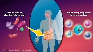 What is Crohns Disease [upl. by Carrel]