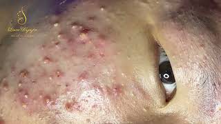 Loan Nguyen Acne Treatment 358pre [upl. by Iralav]