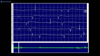 Kimura amp Kohara F17 Fibrillation potentials and positive sharp waves [upl. by Samau]