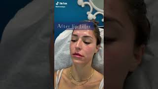 How Lip Fillers Work at Plantation Med Spa Florida shorts [upl. by Ecniuq]