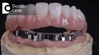 What are Implant Supported Dentures amp for how long do they last  Dr Manesh Chandra Sharma [upl. by Yddeg65]