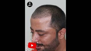 Best Hair Transplant in Jodhpur jodhpurhairtransplant hairtransplantinjodhpur iftclinic [upl. by Georgy]