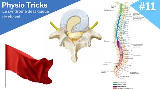 Le syndrome de la queue de cheval identification des symptômes  signes drapeaux rouges [upl. by Llekram420]