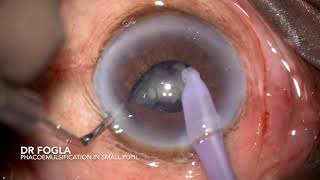 Phacoemulsification in an eye with non dilating small pupil [upl. by Anthiathia]