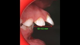 Amazing two phase treatment of Sever Class II Div 1  lama 10Y [upl. by Lednic716]