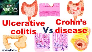 Ulcerative colitis Vs Crohns disease inflammatoryboweldisease [upl. by Kape702]