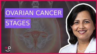 The 4 Stages of Ovarian Cancer by Dr Ruchi Garg [upl. by Marthe]