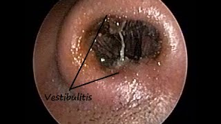 Nose Endoscopy  Vestibulitis due to Chronic Sinusitis  Allergy  Adenoiditis amp PND [upl. by Esinev661]