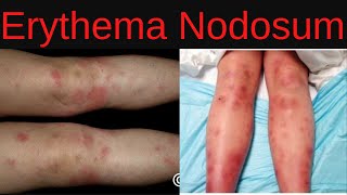 Erythema Nodosum Symptoms Causes Diagnosis Treatment Infections Medications [upl. by Bellaude213]