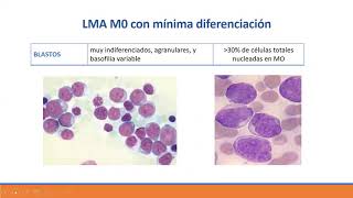 Clase 2 Leucemias Agudas [upl. by Ardiedal]