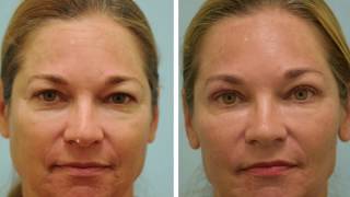 One Week after Upper Blepharoplasty Video and Photos [upl. by Ayota]