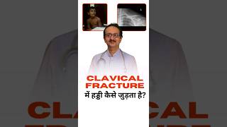 Clavical Fracture  Clavical Fracture में हड्डी कैसी जुड़ती है ।  Collar Bone Fracture in Children [upl. by Powell]