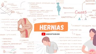 What are hernias  Direct and Indirect  MedStudier [upl. by Soirtimid635]