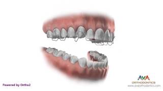 Orthodontic Retainer  Hawley  Instruction and Care [upl. by Clare]