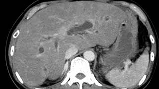 HBP C7 Cholangitis on CT [upl. by Ary471]